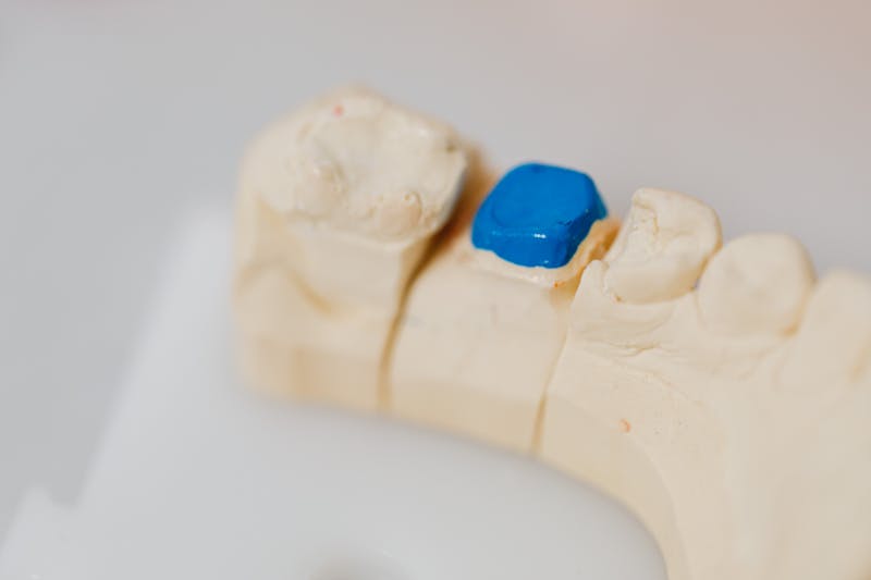Composite filling procedure at Fort Worth Dental - Dentist applying tooth-colored resin in layers with curing light