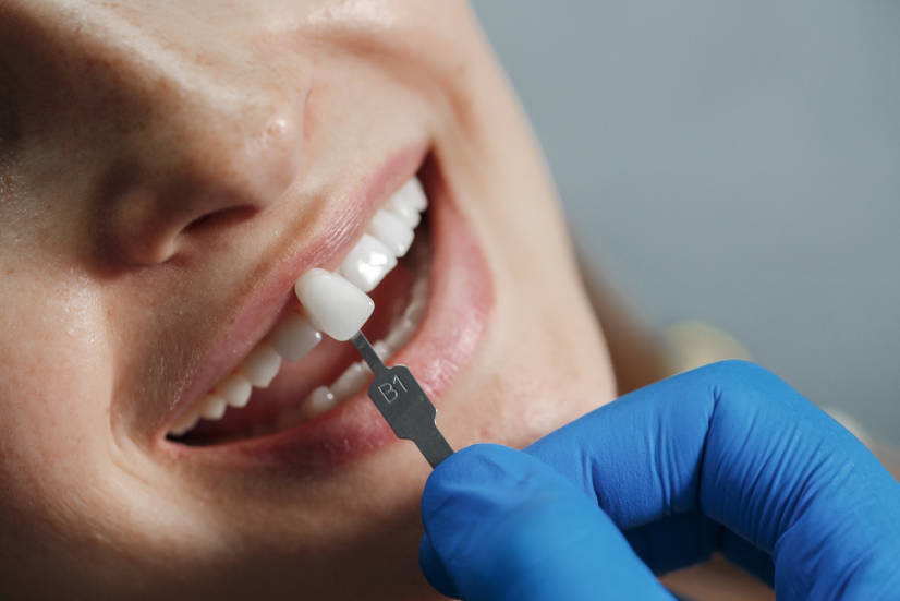 Dental implant procedure diagram showing titanium implant post, abutment, and porcelain crown replacing missing tooth in Fort Worth TX