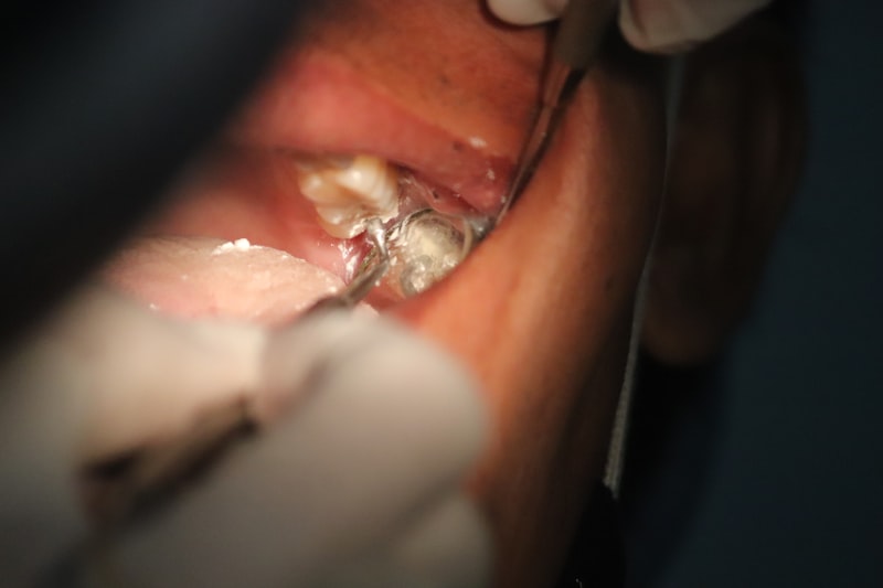 Gingivectomy gum surgery Fort Worth TX - Excess gum tissue removal for healthier smile and improved appearance