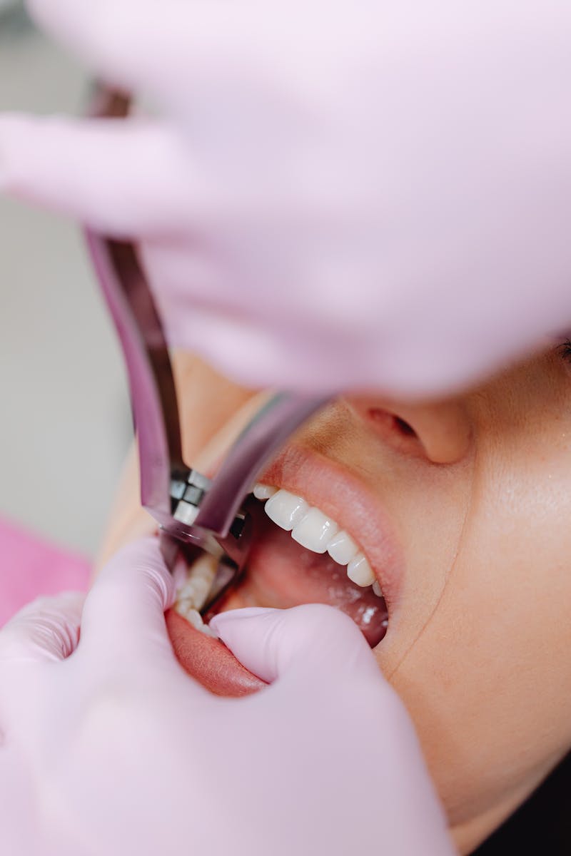 Gingivectomy procedure steps at Fort Worth Dental - Before and after gum reshaping surgery results