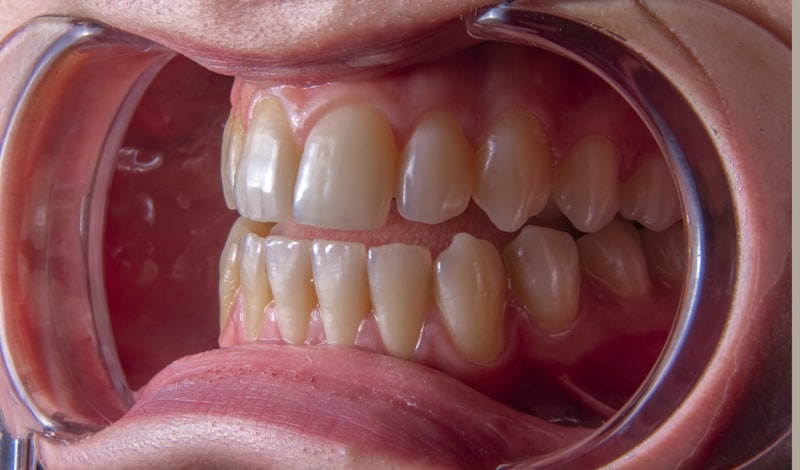 Gum disease periodontal treatment Fort Worth TX - Signs and symptoms of gingivitis and periodontitis