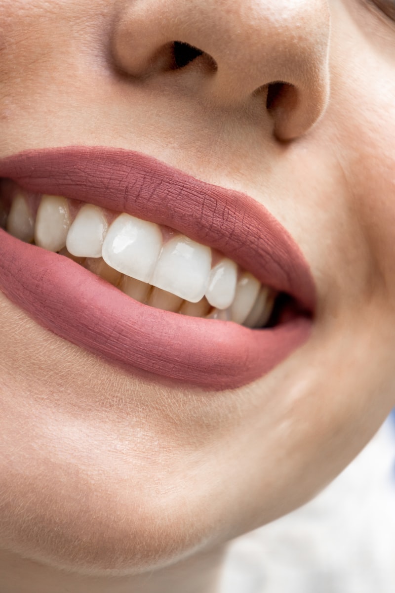Professional teeth whitening treatment at Fort Worth Dental Texas